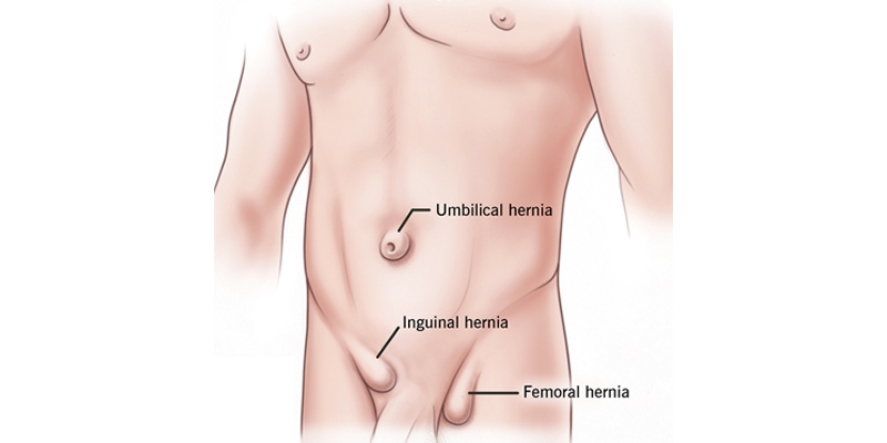 What is an Incisional hernia?