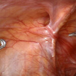 Best Hospital for Hernia Surgery in Chennai