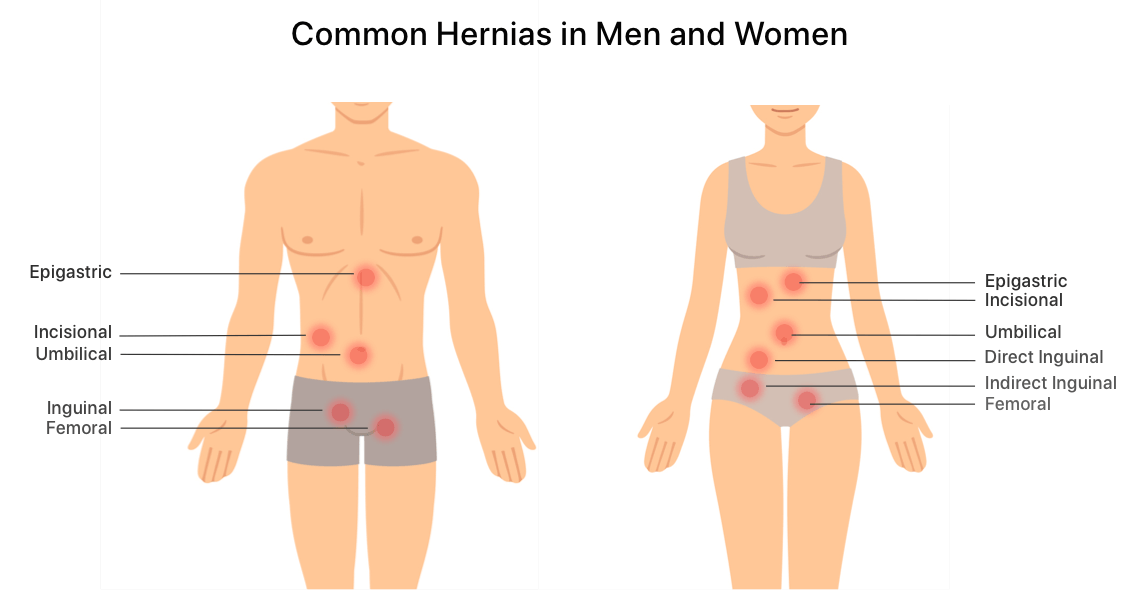 What is the treatment/repair of Incisional Hernia & period of recovery?