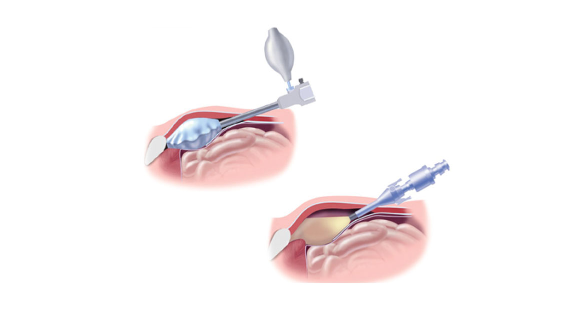Laparoscopic Hernia Surgery