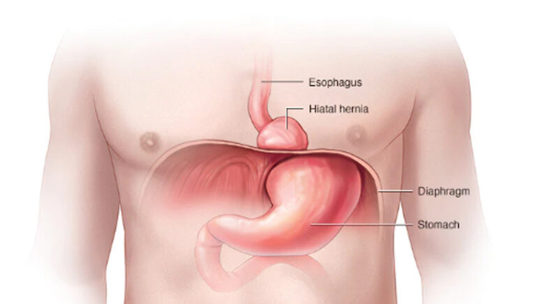 Hiatus hernia