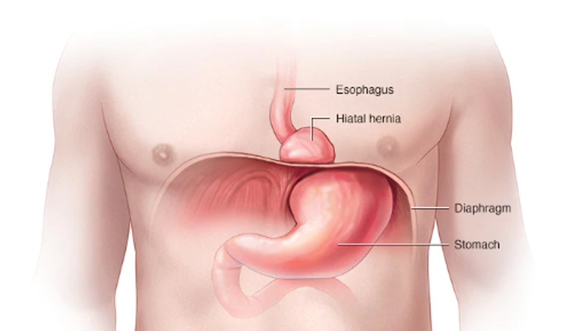 Hiatus hernia