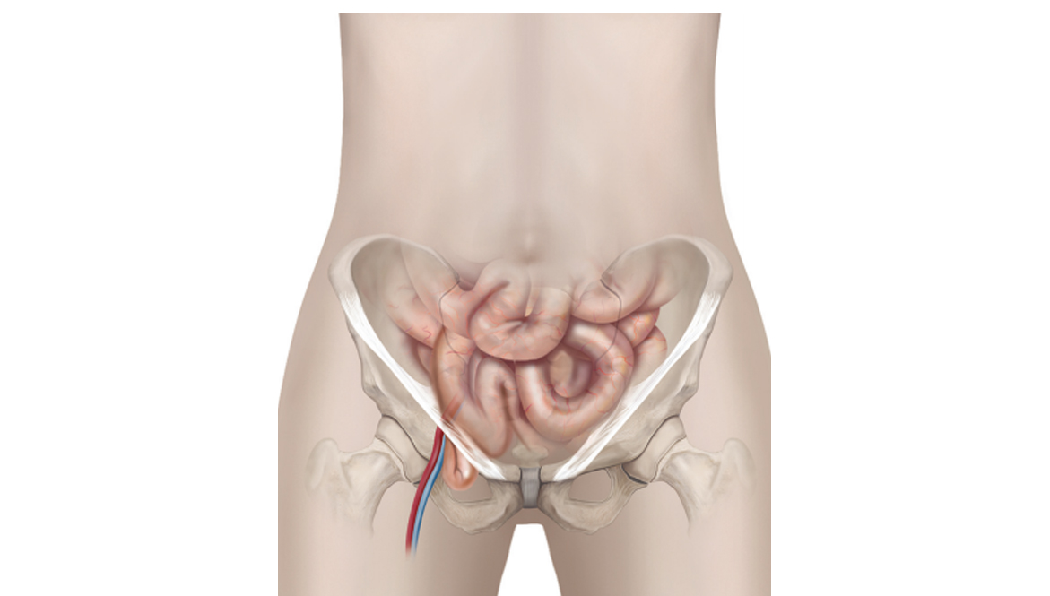 Femoral Hernia