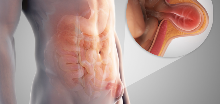 Laparoscopic Hernia Surgery – Keyhole Surgery