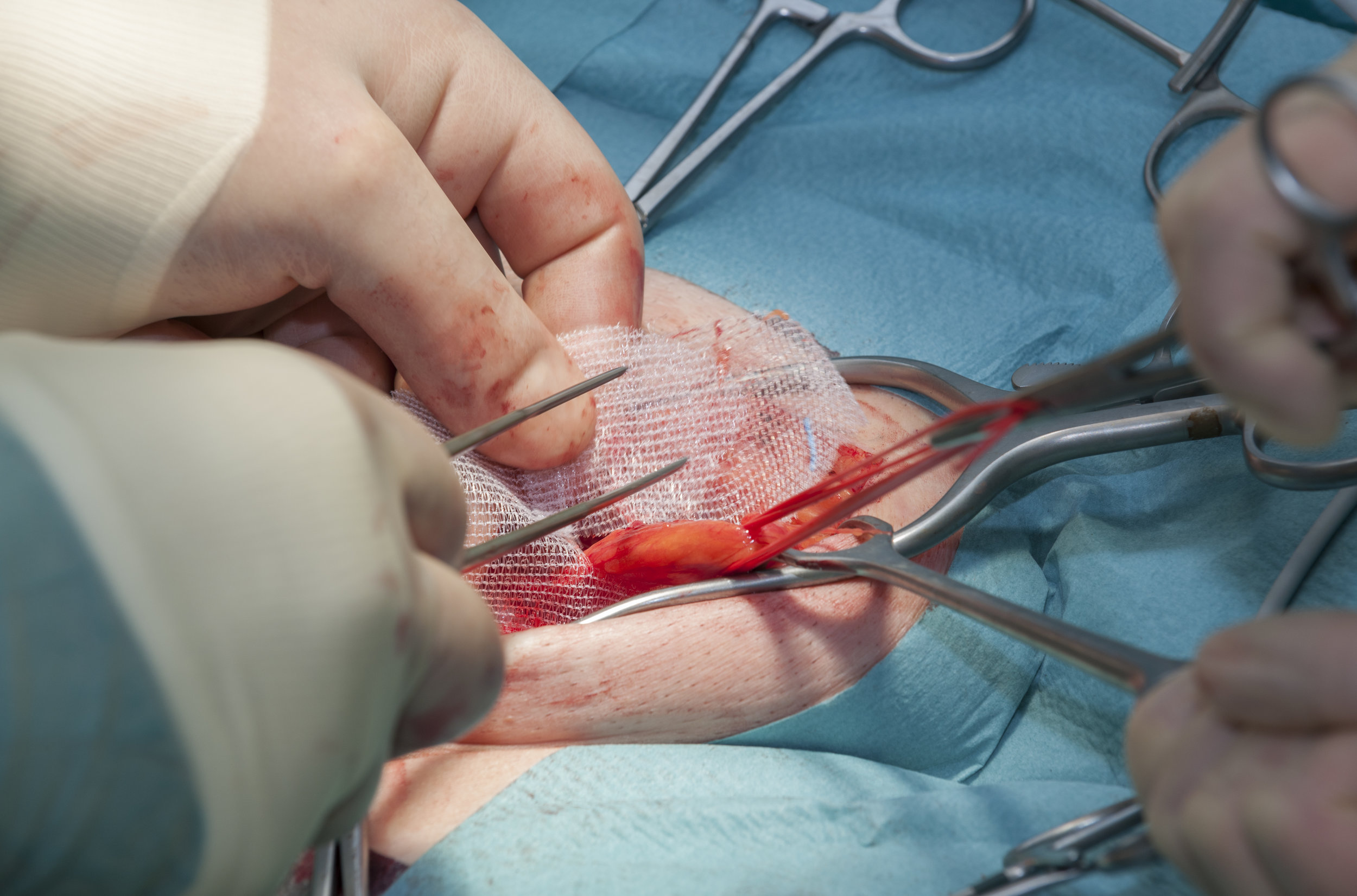 Inguinal Hernia treatment in chennai