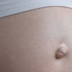 Common Causes of Ventral Hernias