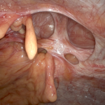 Ventral Hernia Repair Works