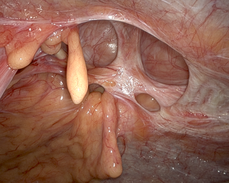 Ventral Hernia Repair Works