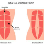 DIVARICATION OF RECTI