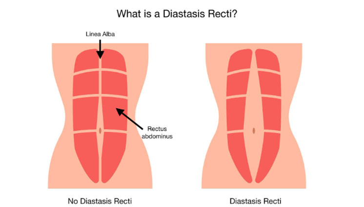 DIVARICATION OF RECTI