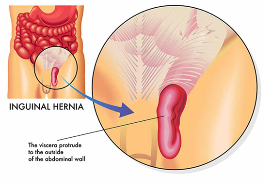 Inguinal Hernia
